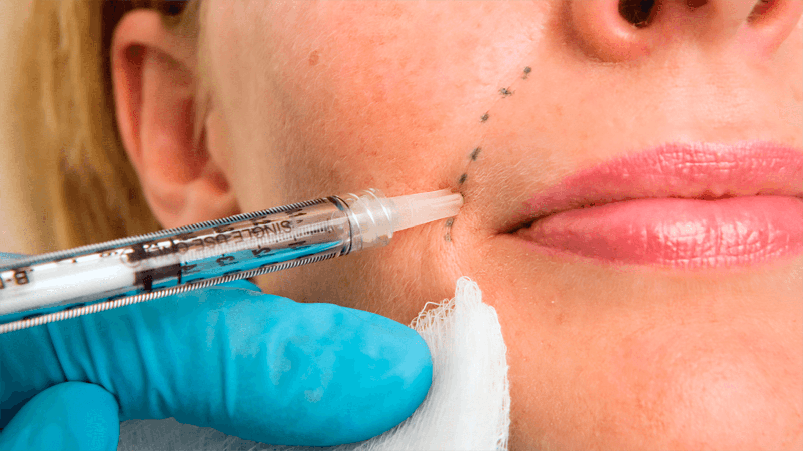 Ästhetische Korrekturen mit harmonyca – Faire Preise garantiert