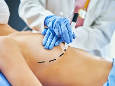 Brustverkleinerung: Die besten Methoden im Überblick