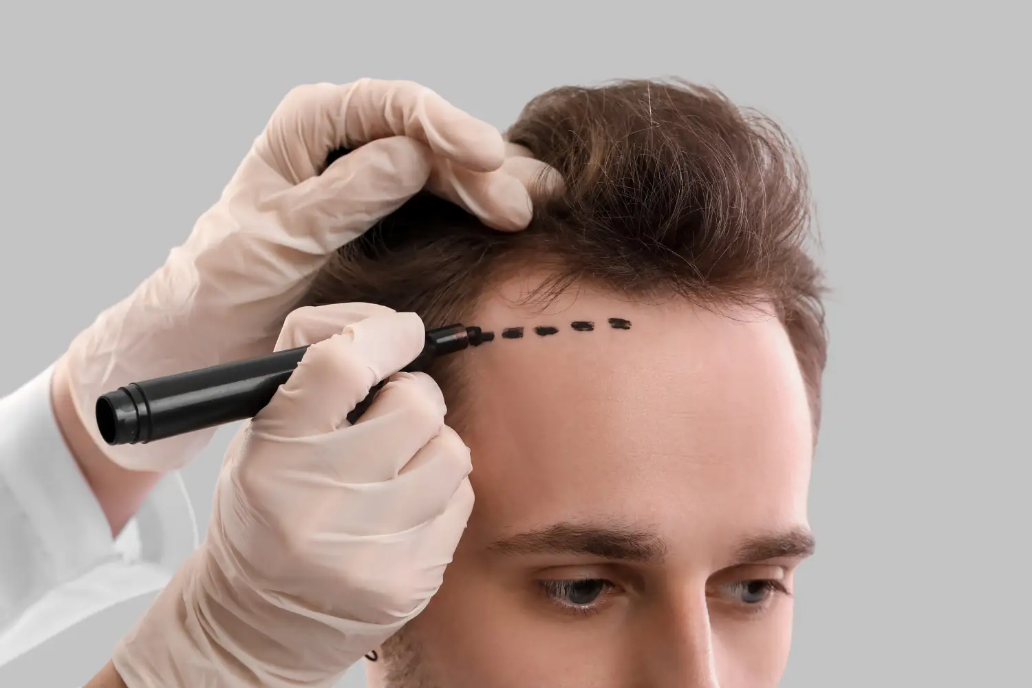 Haartransplantation in istanbul bei genetischem Haarausfall: Behandlungsoptionen erklärt