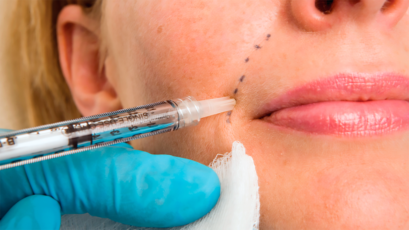 Ästhetische Korrekturen mit harmonyca – Faire Preise garantiert