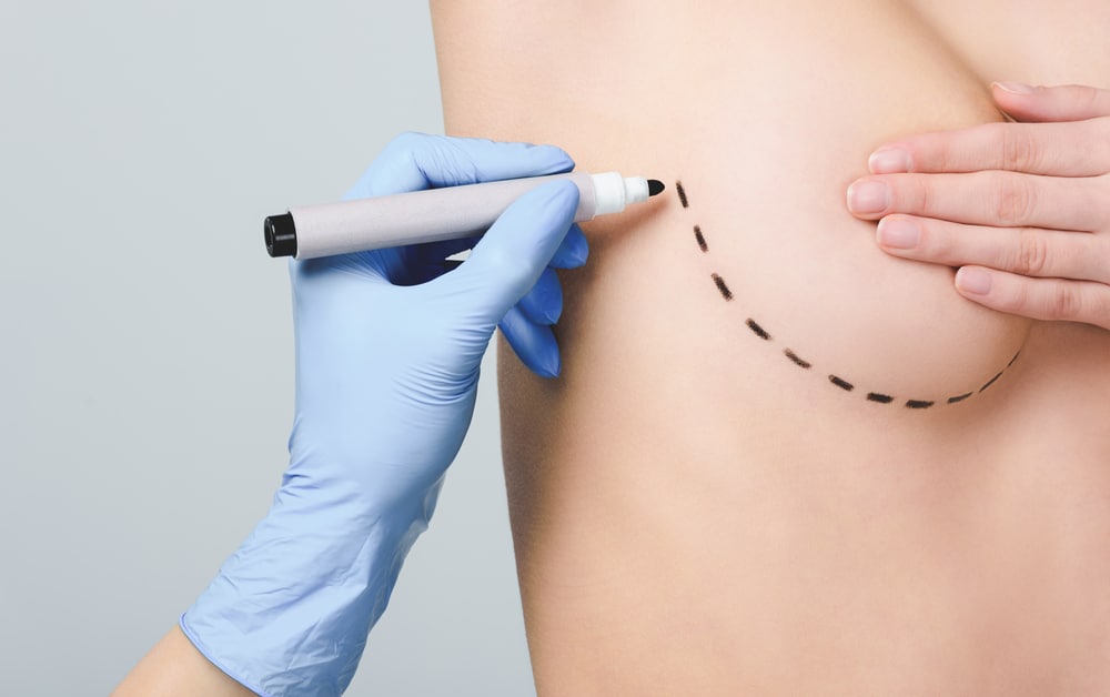 Brustvergrößerung mit Eigenfett oder Implantate: Ein Vergleich